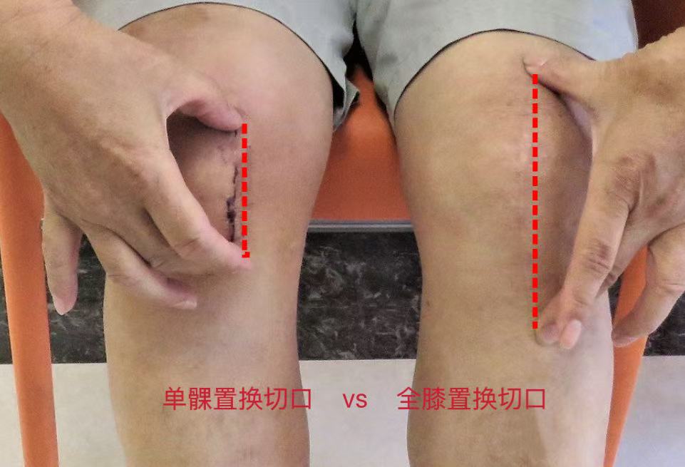 单髁置换宣传图片2
