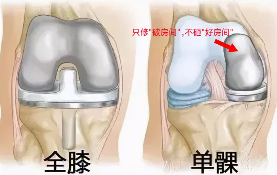 单髁置换宣传图片1